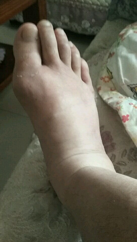 脚肿脚脖子痛使不上力气      